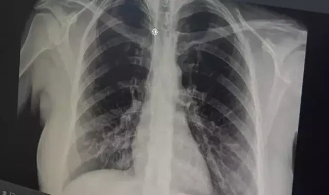 Akut Bronşit Belirtilerine Dikkat! Uzman Uyardı